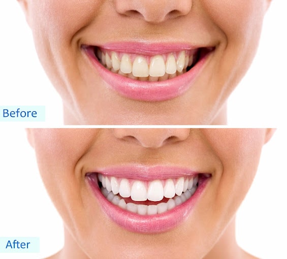Brushing After Whitening Strips